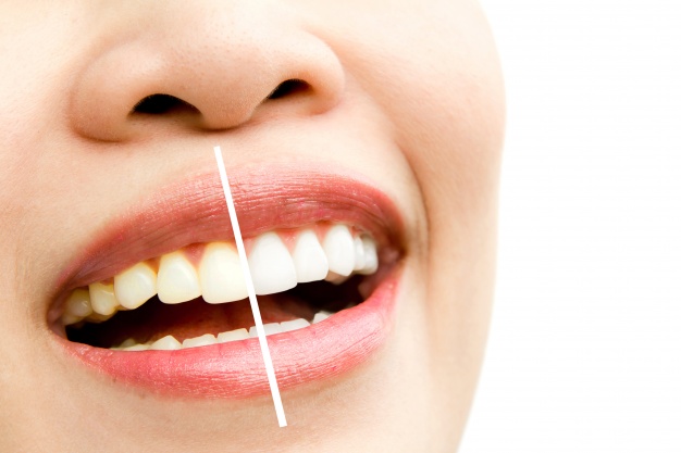 Why You Should Consider Teeth Whitening With Brampton Dentist