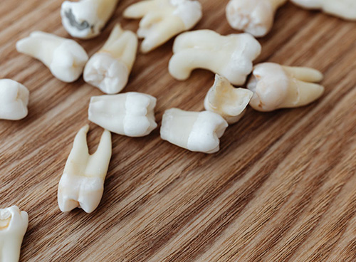 Root-Canal-Brampton