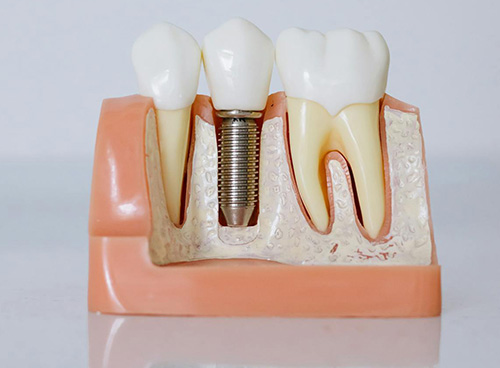 Root-Canal-theropy