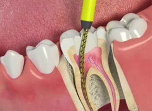 root-canal
